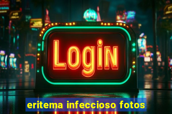 eritema infeccioso fotos
